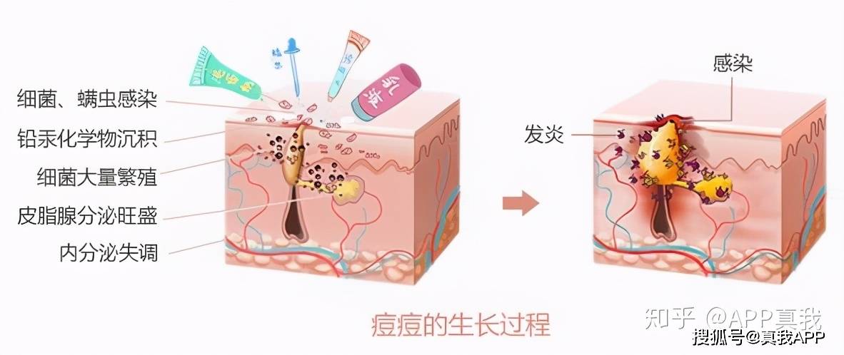 上火下寒体质怎么调理下巴长痘痘_上火下寒体质怎么调理下巴长痘痘_上火下寒体质怎么调理下巴长痘痘