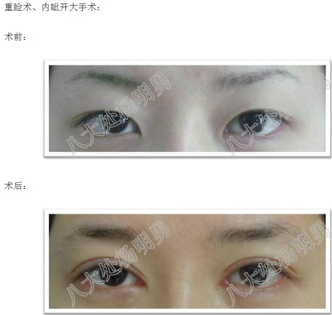 化妆开外眼角_开了眼角化妆了会有什么影响_化妆怎么开眼角