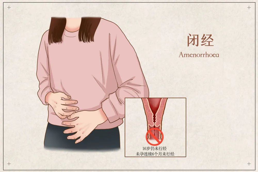 闭经吃阿胶能来月经吗_阿胶对治疗闭经有功效吗_闭经能吃阿胶调理吗