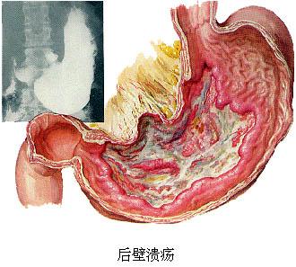 肠胃功能紊乱食疗食谱_调理肠胃食谱功能紊乱的药_肠胃功能紊乱调理食谱