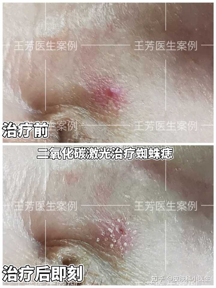 激光去除眼线是不是特别疼_激光去除眼线_激光除眼线