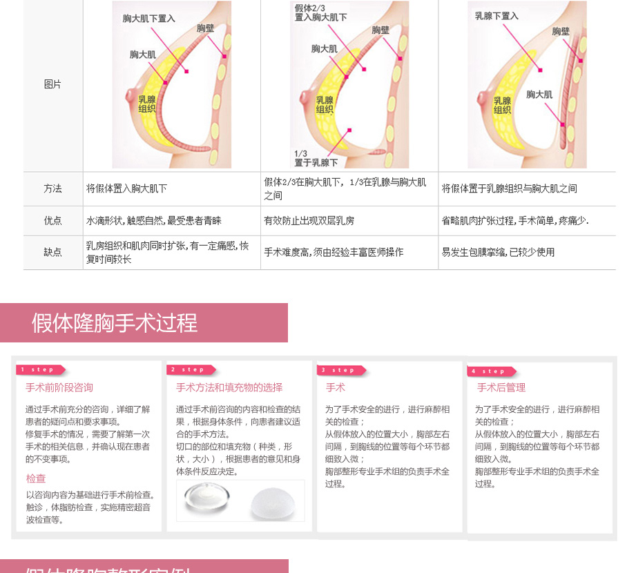 假体丰胸的咨询流程_丰胸假体安全吗_假体丰胸价格 39健康问答网