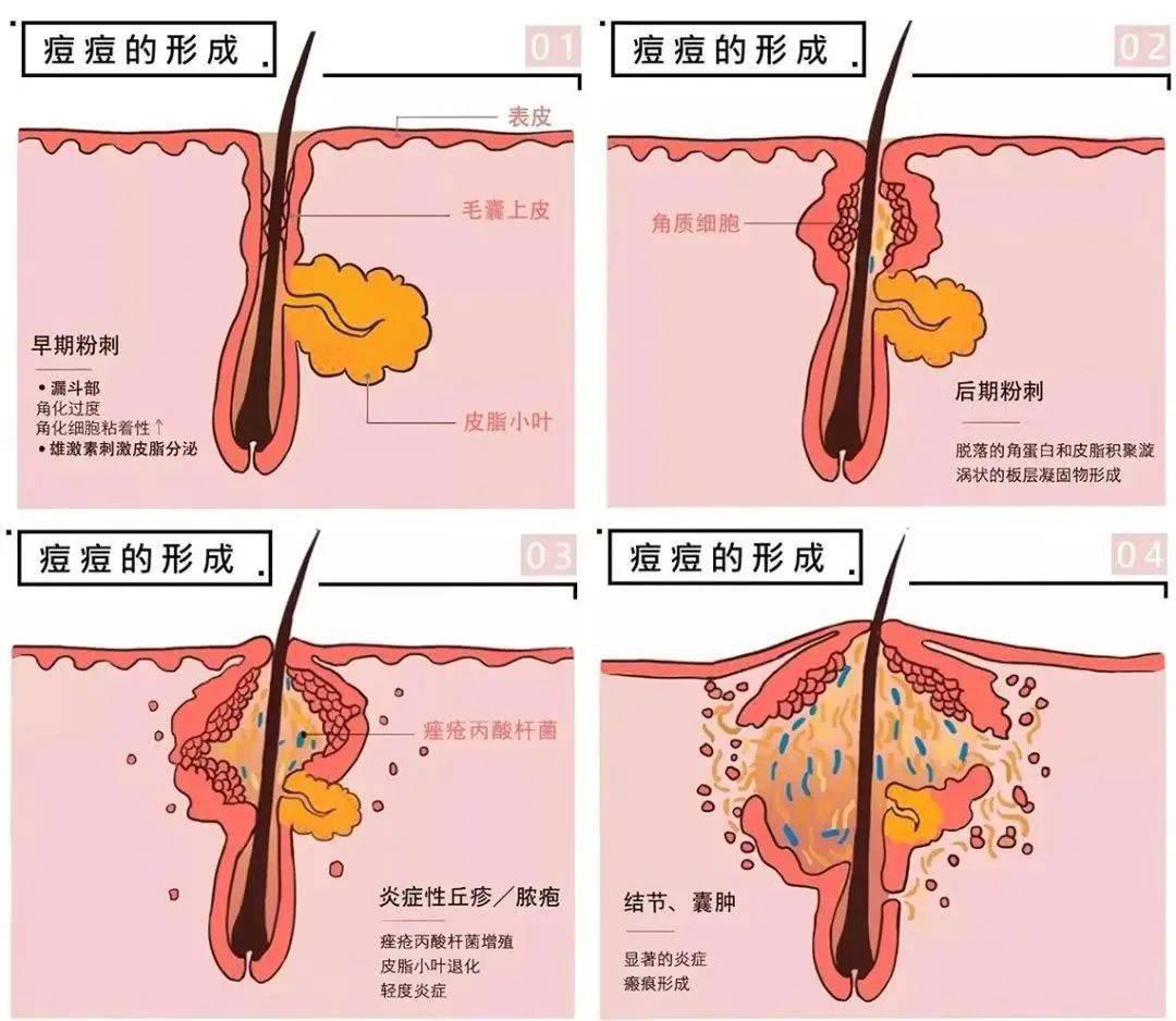 女人内分泌失调长痘吃啥药_女生长痘痘内分泌失调_女性内分泌失调长痘痘怎么调理